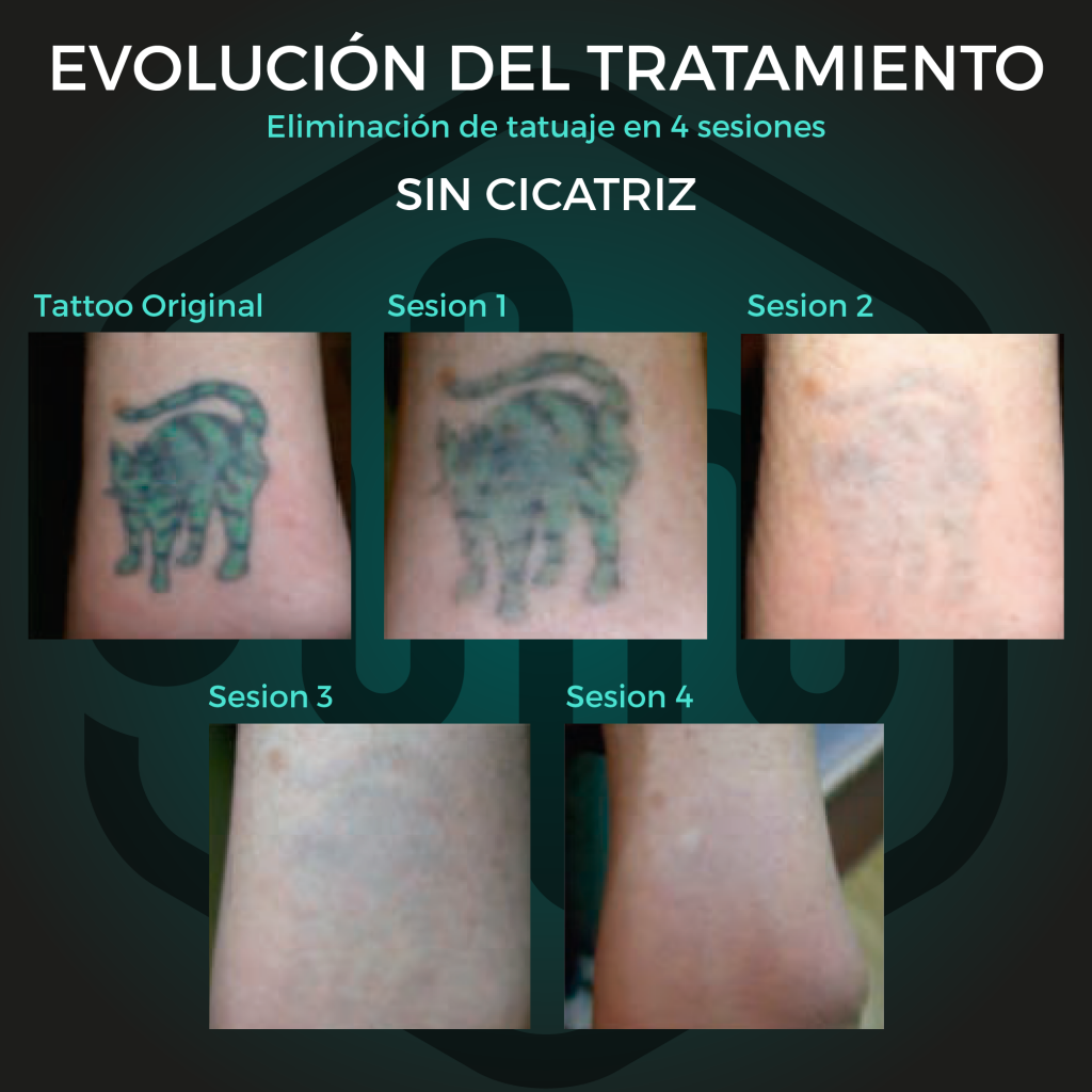 Eliminación de tatuajes – House of Machines Tattoo & Piercing