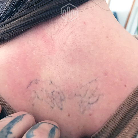 cómo acelerar la eliminación de tatuajes